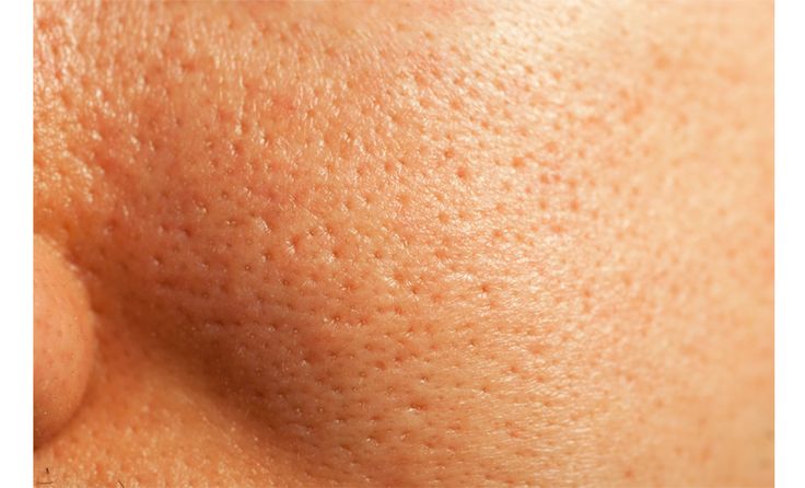 Enlarged pores